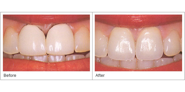  Teeth Whitening 